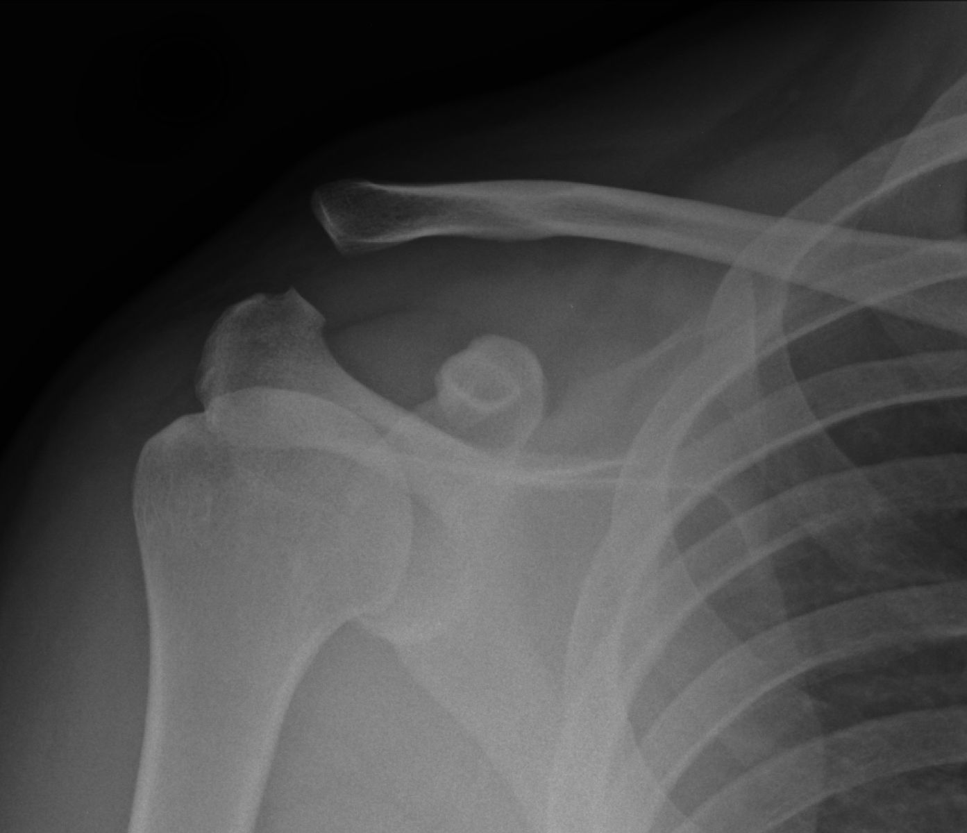 AcromioClavicular Joint Separation West Midlands ACJ Dislocation